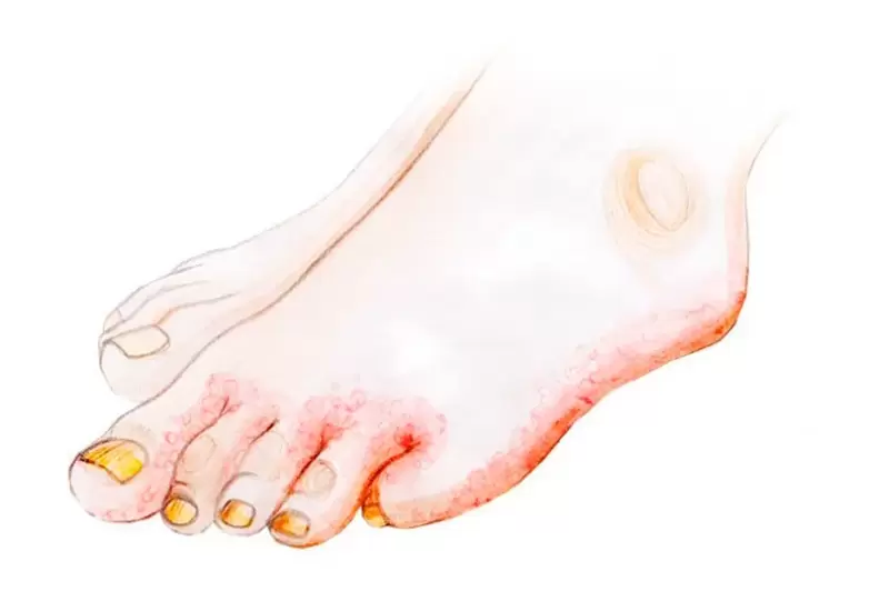 Champignon sur les orteils et comment appliquer la crème Zenidol