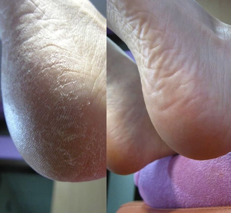 Photo du talon du pied avant et après l'utilisation de la crème Zenidol