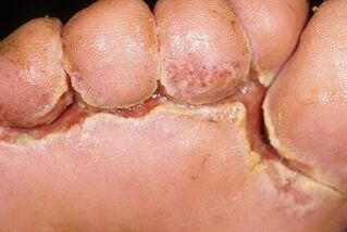 Symptômes de mycose des ongles