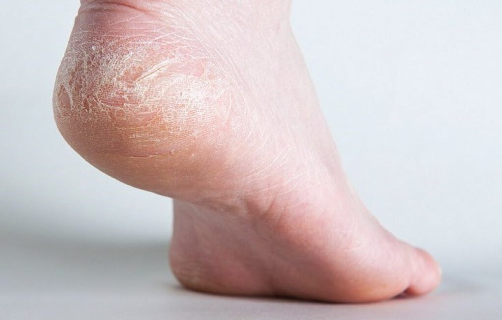 comment traiter les champignons de la peau sur la jambe