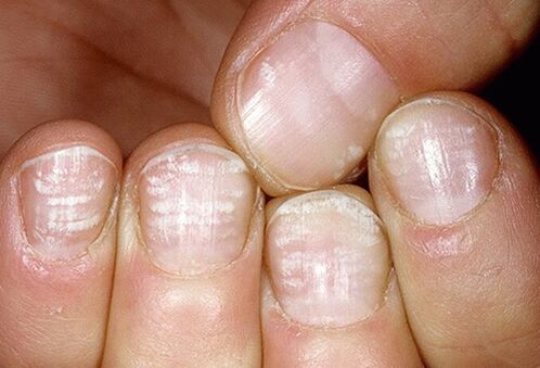 Infection fongique de la plaque à ongles