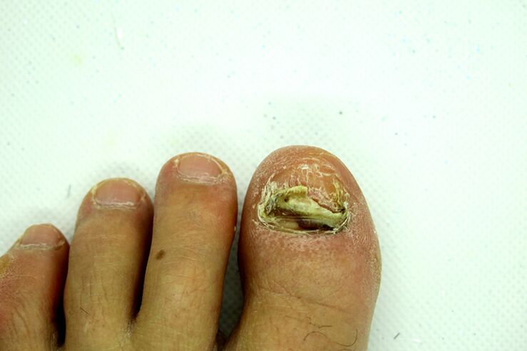 Champignon de ongle - scène lourde