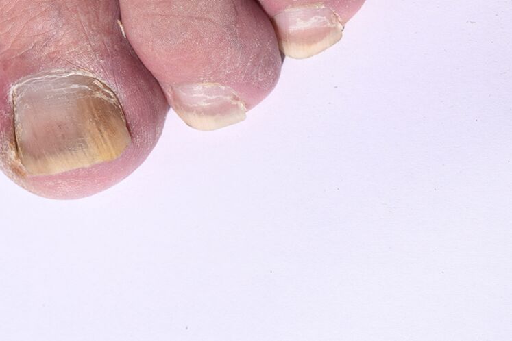 La phase initiale de la mycose des ongles sur les jambes