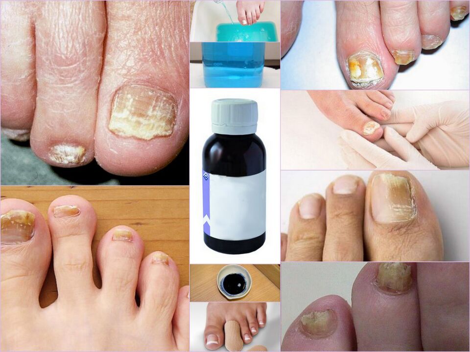 Médicament contre la mycose des ongles des pieds