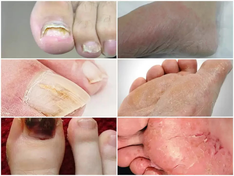 Manifestations de champignons sur les pieds causées par divers agents pathogènes