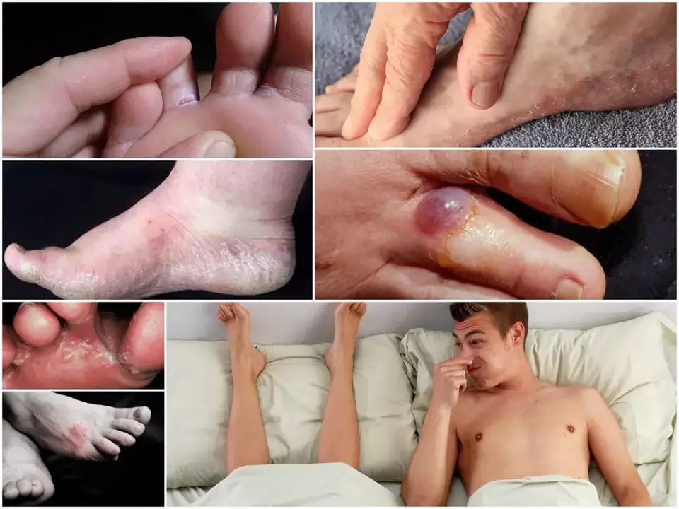 Principaux symptômes du pied d'athlète