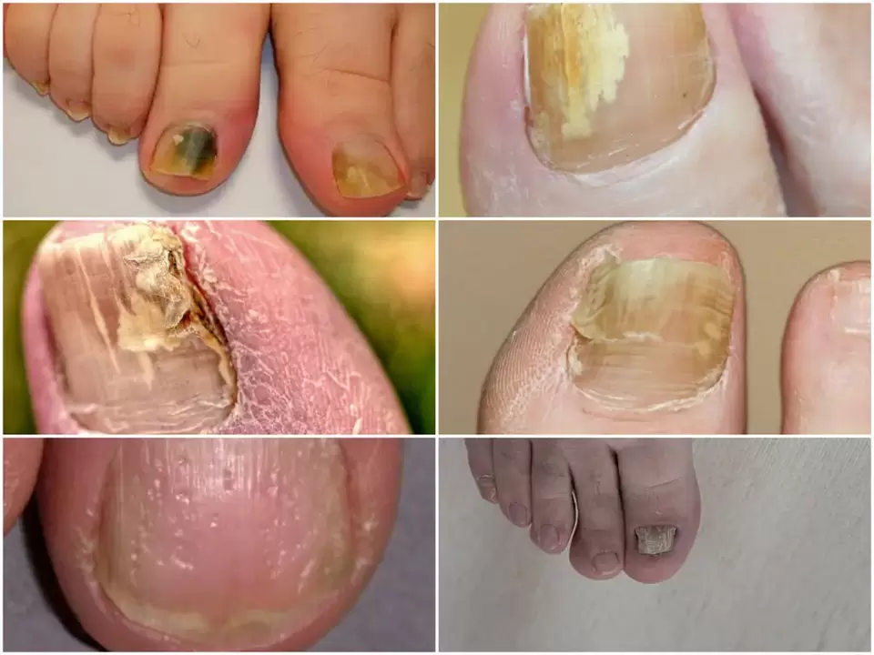 Symptômes de l'onychomycose – changements dans la couleur et la structure des ongles