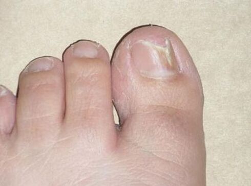 Dommages à la plaque à ongles dus à une attaque fongique