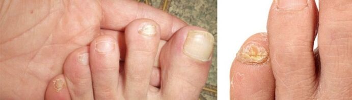 Photo de manifestations fongiques sur les ongles des pieds