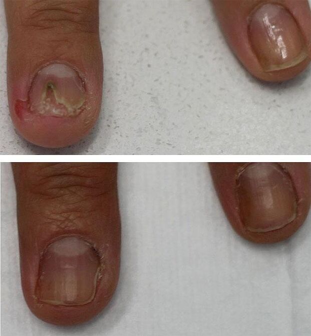 Infection fongique des ongles