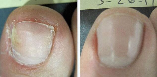 avant et après le traitement de la mycose des ongles