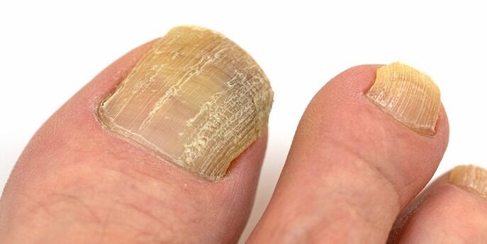 Dommages aux ongles avec infection fongique avancée