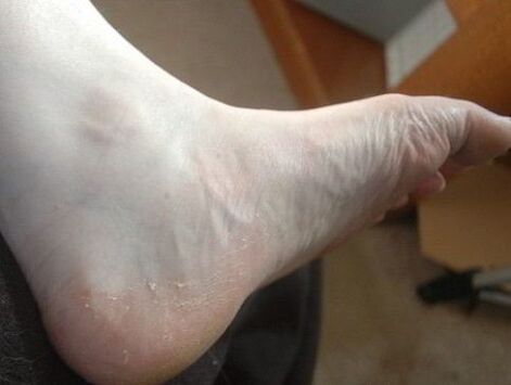 Pelage du pied de la jambe comme signe d'une infection fongique